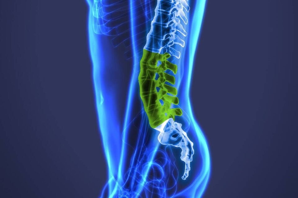 Spinal Implants