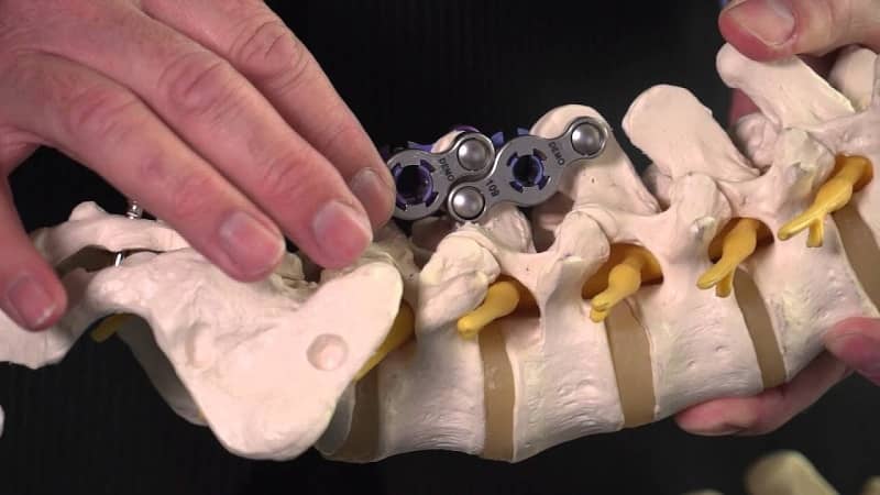 What are Spinal Implants