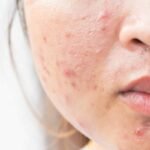Get Rid of Scars