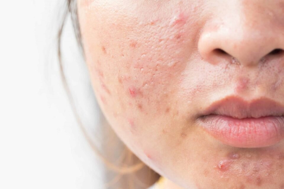 Get Rid of Scars