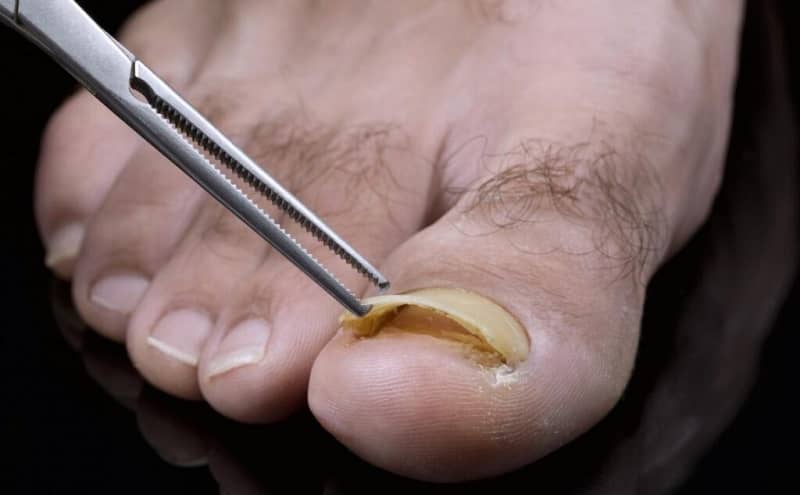 Destroy Your Nail Fungus