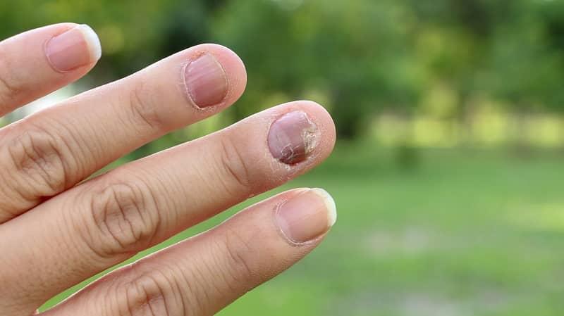 What is Nail Fungus