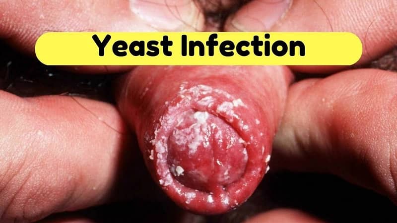 male yeast infection symptom